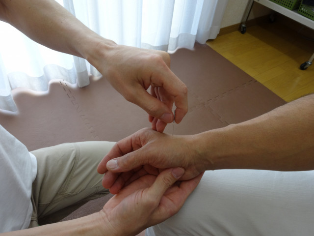 不妊症に対する鍼灸治療