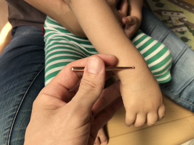 かんむしの改善のため小児鍼をする子供